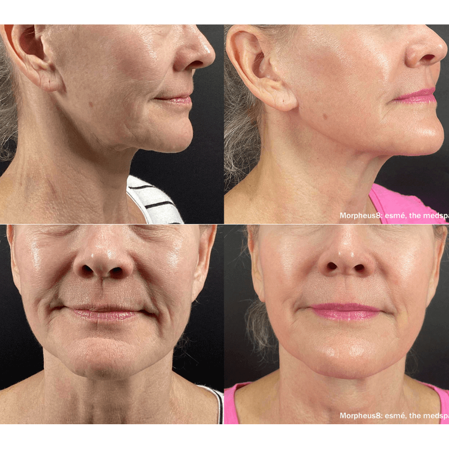 Morpheus8 Before/After